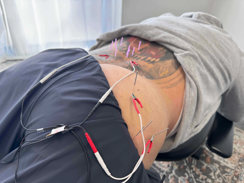 man with tattoo on his back doing dry needling therapy